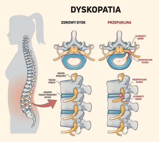 Jakie zawody są odpowiednie przy dyskopatii?