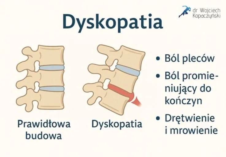 Dyskopatia w pracy